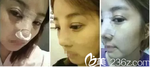 剛做完眼鼻整形術(shù)后腫脹 剛做完眼鼻整形術(shù)后腫脹