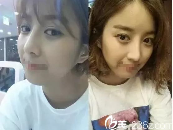 眼鼻整形術(shù)后半個(gè)月恢復(fù) 眼鼻整形術(shù)后半個(gè)月恢復(fù)