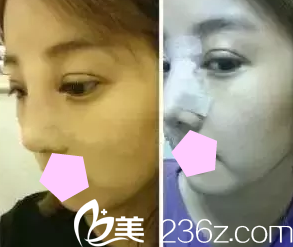 太原華美尹衛(wèi)民醫(yī)生給我做雙眼皮和鼻綜合術后第3天照片