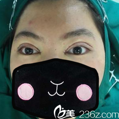 <!--<i data=20240703-sp></i>-->切開(kāi)雙眼皮+祛皮祛脂+開(kāi)內(nèi)眼角術(shù)