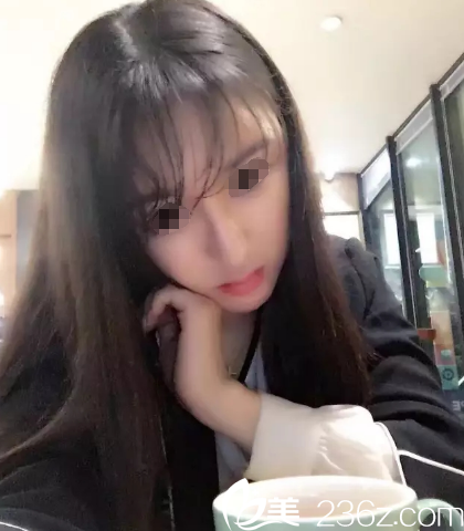 在蘇州美貝爾做線雕術(shù)后恢復(fù) 在蘇州美貝爾做線雕術(shù)后恢復(fù)