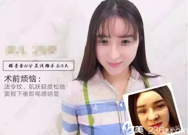 線雕前后對(duì)比案例 線雕前后對(duì)比案例