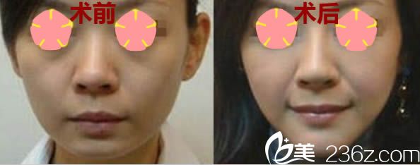 全面部提升案例及前后對(duì)比效果