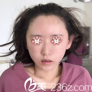 面部填充術(shù)后即刻 面部填充術(shù)后即刻