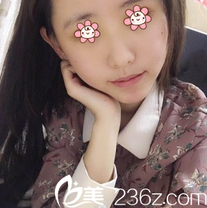 朱紅振自體脂肪面部填充術(shù)后一周 朱紅振自體脂肪面部填充術(shù)后一周