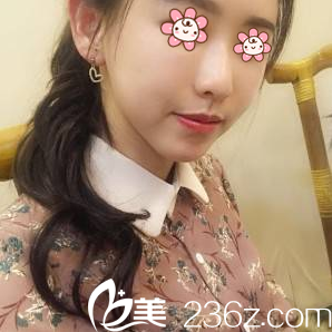 重慶聯(lián)合麗格朱紅振面部脂肪填充術(shù)后19天 重慶聯(lián)合麗格朱紅振面部脂肪填充術(shù)后19天