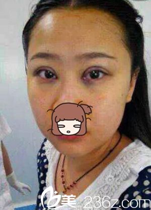 許昌麗娜整形做雙眼皮 許昌麗娜整形做雙眼皮