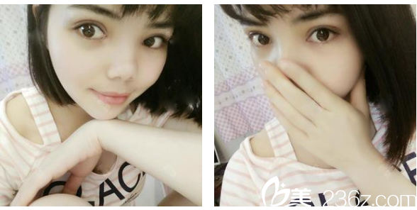 茂名華美雙眼皮案例術后七天拆線圖 茂名華美雙眼皮案例術后七天拆線圖