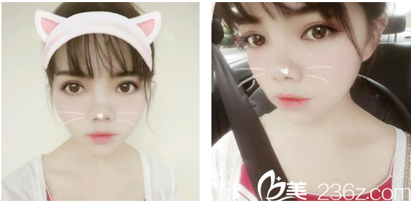 想了很久還是決定找茂名華美整形醫(yī)院生醫(yī)生做了切開雙眼皮