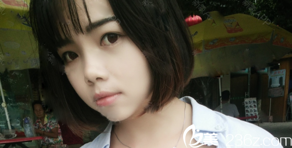 術前單眼皮照片 術前單眼皮照片