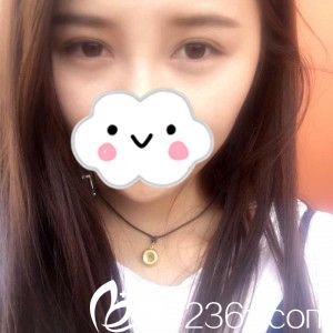 我在衡陽曹家整形做的雙眼皮，看我的整個(gè)過程，相信你也會為劉健院長的技術(shù)點(diǎn)贊