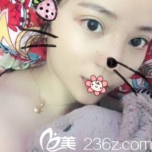 戴霞鼻綜合術(shù)后8天 戴霞鼻綜合術(shù)后8天