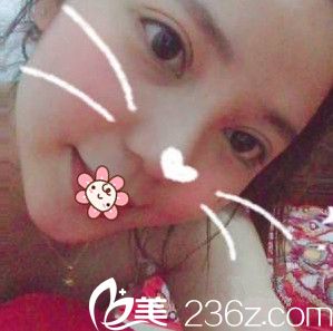 重慶好美整形眼綜合術(shù)后13天 重慶好美整形眼綜合術(shù)后13天