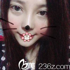 重慶好美整形鼻綜合術(shù)后19天 重慶好美整形鼻綜合術(shù)后19天