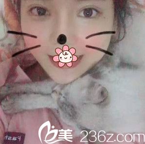 重慶好美整形戴霞眼綜合24天 重慶好美整形戴霞眼綜合24天