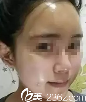 太原華美自體脂肪墊下巴豐太陽穴豐面頰術(shù)后第7天效果