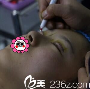 雙眼皮術(shù)前畫線 雙眼皮術(shù)前畫線