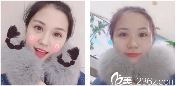 連老爸都夸我在深圳博愛曙光醫(yī)院找賈維順做的切開雙眼皮又好看又自然