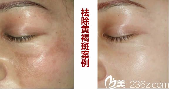 廈門舒友千慕激光祛斑案例圖