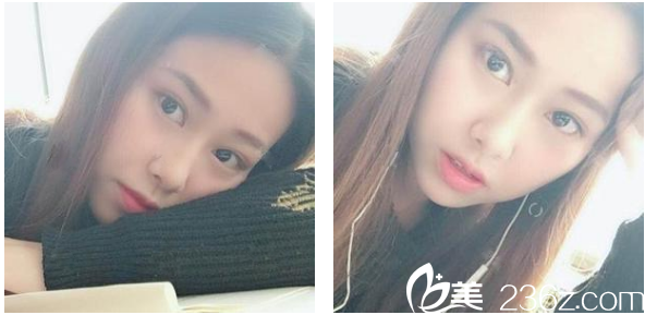 找深圳博愛整形醫(yī)院賈維順做鼻綜合術(shù)后兩周恢復效果圖 找深圳博愛整形醫(yī)院賈維順做鼻綜合術(shù)后兩周恢復效果圖