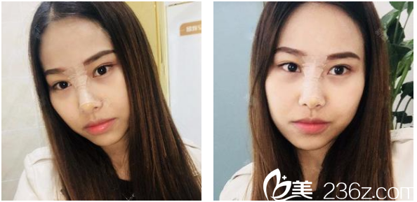 去深圳博愛整形醫(yī)院做完假體和耳軟骨隆鼻五天圖片 去深圳博愛整形醫(yī)院做完假體和耳軟骨隆鼻五天圖片