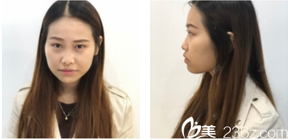 術(shù)前塌鼻梁圖片 術(shù)前塌鼻梁圖片