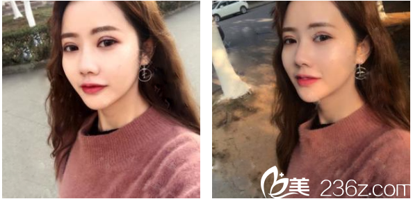 廣州壹加壹整形醫(yī)院項(xiàng)美蓮雙眼皮術(shù)后兩周恢復(fù)效果圖