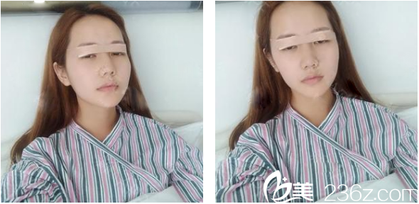 來(lái)找廣州壹加壹整形醫(yī)院做完雙眼皮第二天圖片