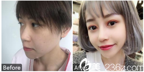 廣州壹加壹整形外科李明醫(yī)生做的膨體隆鼻實(shí)例圖 廣州壹加壹整形外科李明醫(yī)生做的膨體隆鼻實(shí)例圖