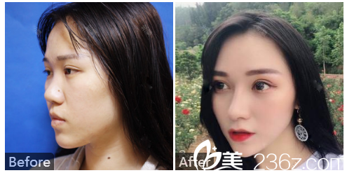 廣州壹加壹整形外科李明醫(yī)生肋軟骨鼻綜合隆鼻實(shí)例療效圖片 廣州壹加壹整形外科李明醫(yī)生肋軟骨鼻綜合隆鼻實(shí)例療效圖片