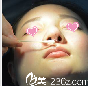 北京壹加壹丁洪如鼻綜合案例手術(shù)當(dāng)天照 北京壹加壹丁洪如鼻綜合案例手術(shù)當(dāng)天照