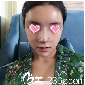 北京壹加壹醫(yī)療美容醫(yī)院隆鼻案例術(shù)后4天效果 北京壹加壹醫(yī)療美容醫(yī)院隆鼻案例術(shù)后4天效果