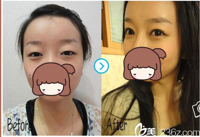 常熟時(shí)代雙眼皮整形案例