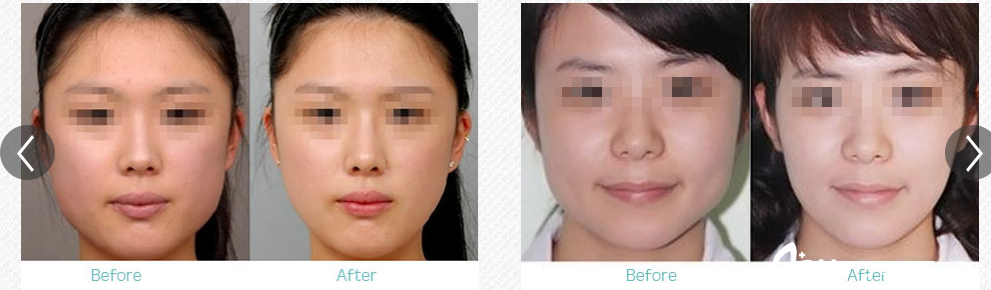 常熟時(shí)代瘦臉案例