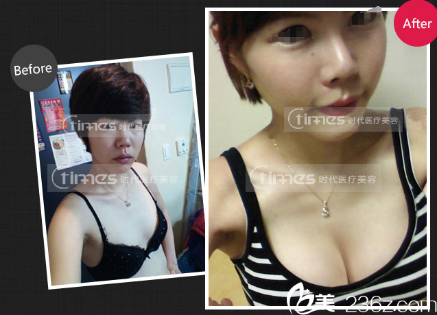 常熟時(shí)代豐胸案例