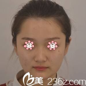 打算去重慶光博士整形前的我 打算去重慶光博士整形前的我