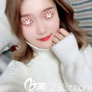 才俊明下頜角整形術(shù)后18天 才俊明下頜角整形術(shù)后18天