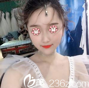 重慶光博士整形下頜角手術(shù)33天 重慶光博士整形下頜角手術(shù)33天