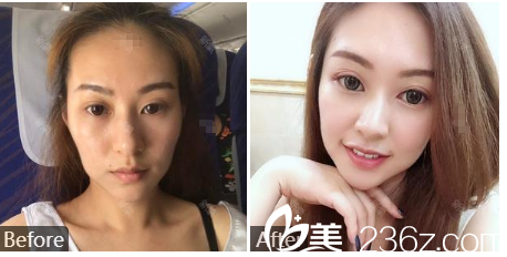 廣州廣美整形美容醫(yī)院余花面部<span style= 廣州廣美整形美容醫(yī)院余花面部<span style=