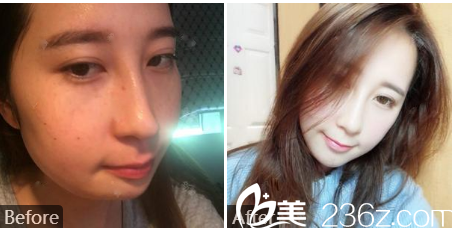 廣州廣美整形美容醫(yī)院余花自體脂肪全臉填充案例對比圖 廣州廣美整形美容醫(yī)院余花自體脂肪全臉填充案例對比圖