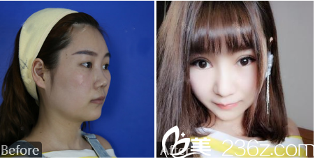 廣州廣美余花醫(yī)生雙眼皮和隆鼻案例對比圖 廣州廣美余花醫(yī)生雙眼皮和隆鼻案例對比圖