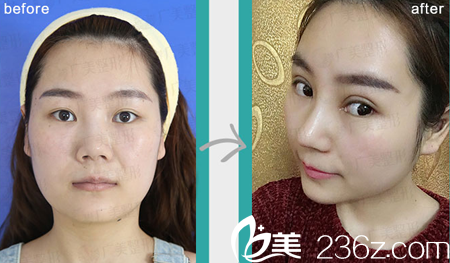 廣州廣美整形美容醫(yī)院隆鼻案例圖 廣州廣美整形美容醫(yī)院隆鼻案例圖