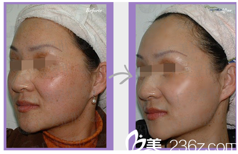 廣州廣美整形美容醫(yī)院激光祛斑案例圖 廣州廣美整形美容醫(yī)院激光祛斑案例圖