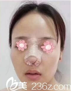長沙雅美鼻綜合術后天