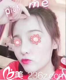 在長沙雅美做鼻綜合術后半個月