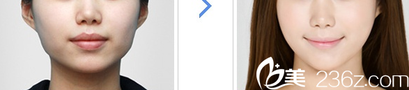 韓國SoonPlus整形外科醫(yī)院面部輪廓整形案例
