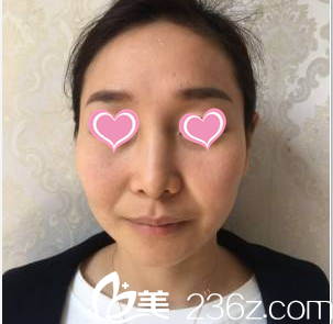 韓國SoonPlus醫(yī)院金順東鼻部整形案例術(shù)前照 韓國SoonPlus醫(yī)院金順東鼻部整形案例術(shù)前照