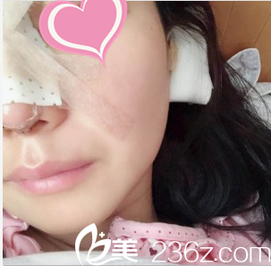 金順東鼻部整形案例術(shù)后第二天樣子 金順東鼻部整形案例術(shù)后第二天樣子