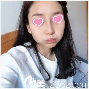 韓國SoonPlus整形醫(yī)院鼻綜合案例術(shù)后23天效果 韓國SoonPlus整形醫(yī)院鼻綜合案例術(shù)后23天效果