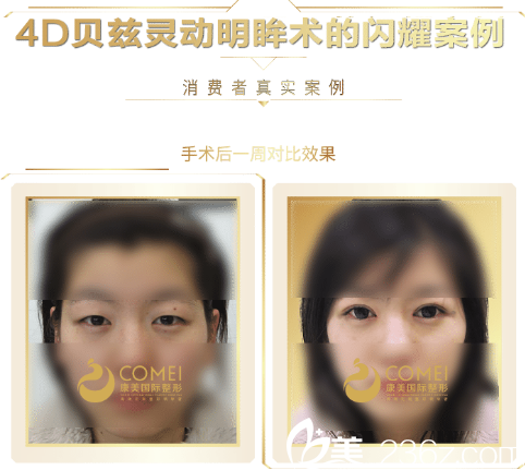 張悅迪醫(yī)生雙眼皮案例